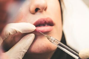 botox lip flip