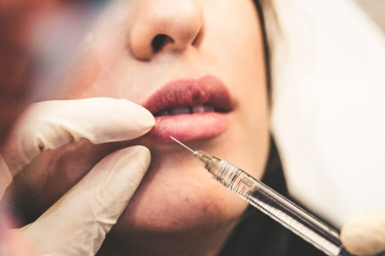 botox lip flip