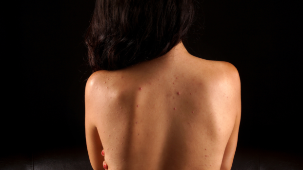 Top Back and Butt Acne Treatments