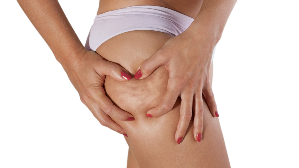 QWO Cellulite Treatment in Reston