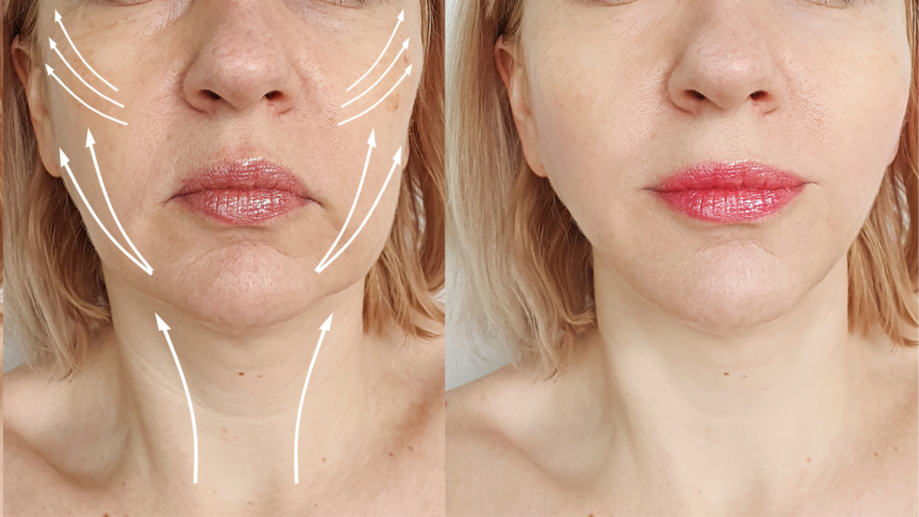 Choosing the Best Wrinkle Eraser for Your Face Reston Dermatology