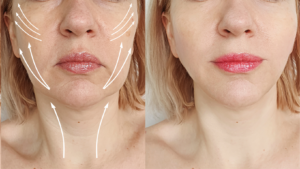 Best Wrinkle Eraser for Your Face