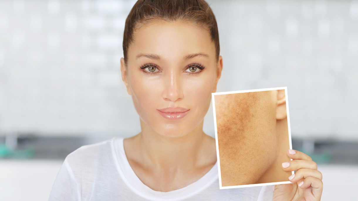 Best Lasers for Dark Spot Removal Reston Dermatology + Cosmetic Center