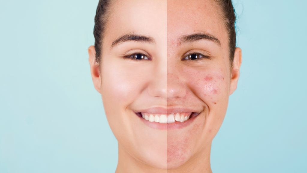 Dermatologist Specializing in Acne Near Me