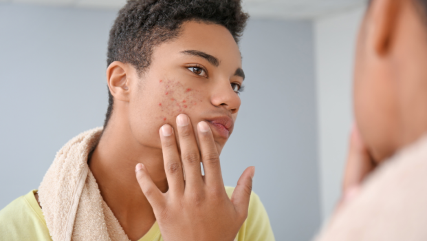 Back to School Acne Tips From a Dermatologist
