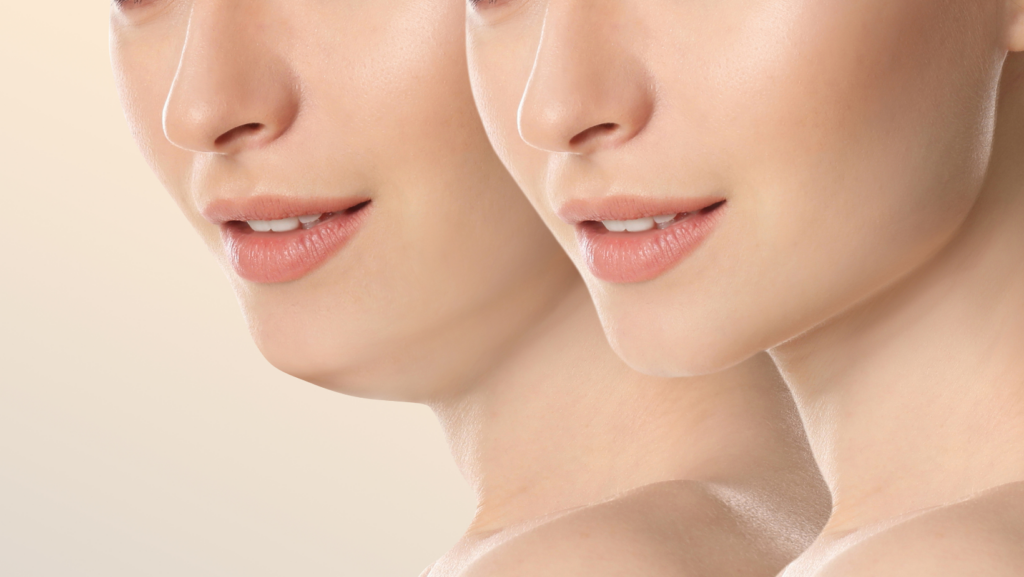 How to Get Rid of a Double Chin