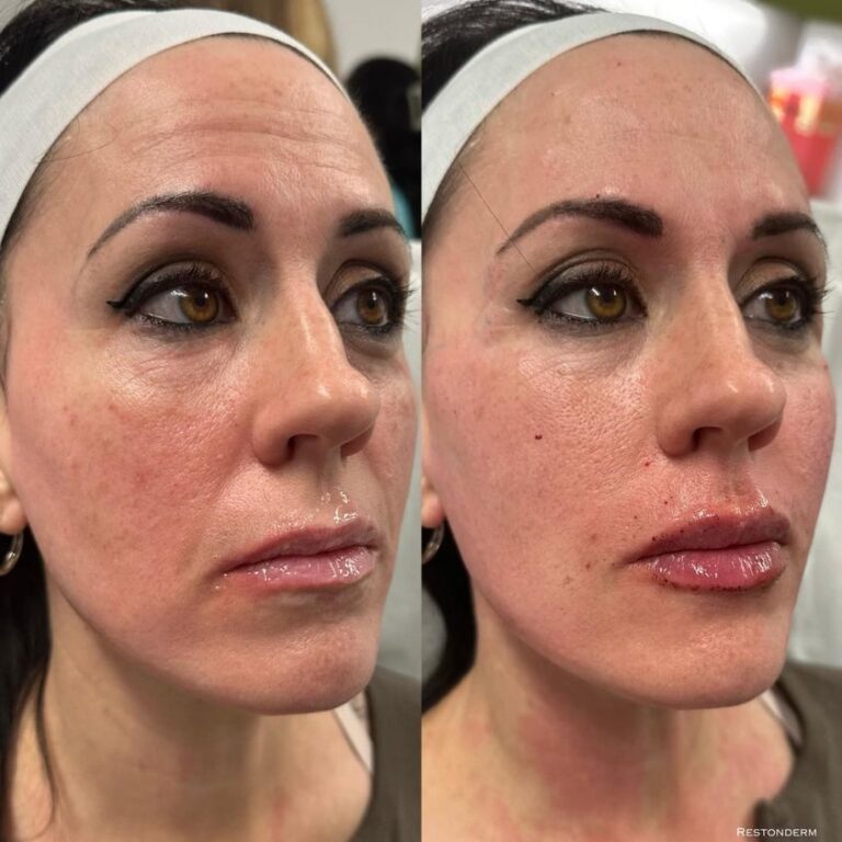 Botox Lip Flip