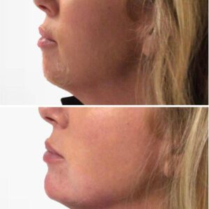 cost of non-surgical chin augmentation