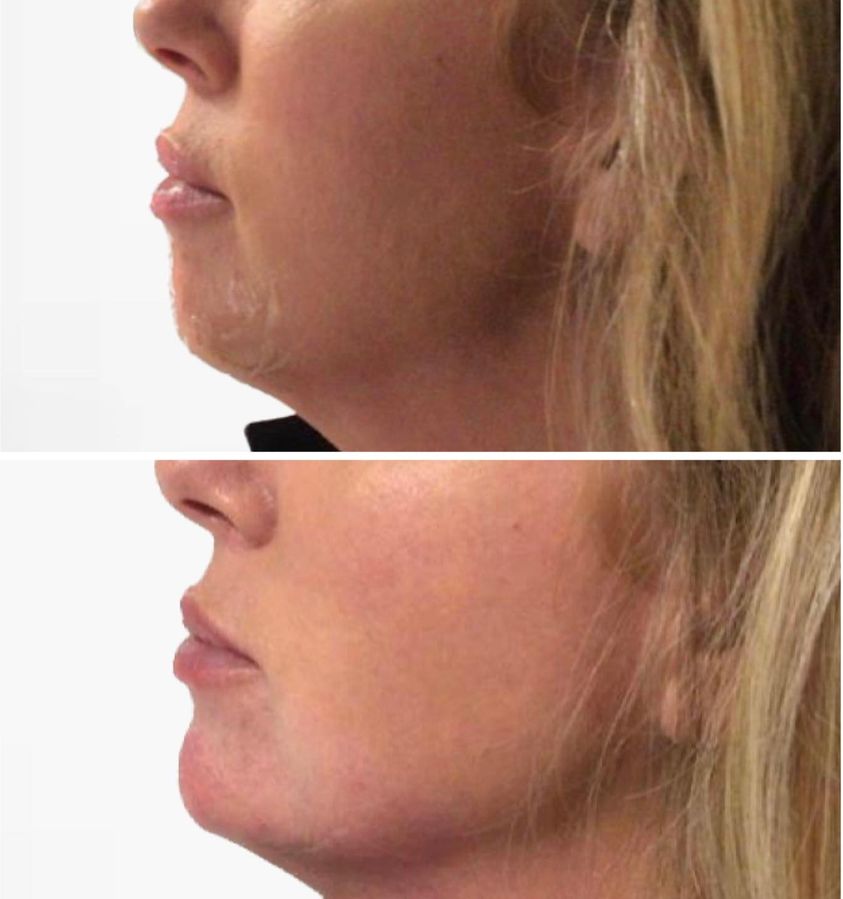 cost of non-surgical chin augmentation