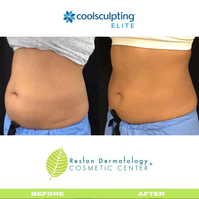 How to Get Rid of Your Muffin Top: the CoolSculpting Approach - Reston  Dermatology + Cosmetic Center