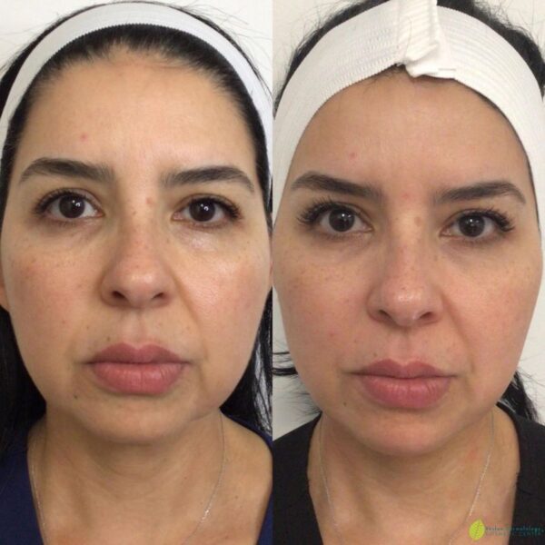 Best Treatments for Ozempic Face Aging and Butt Fat Loss Reston