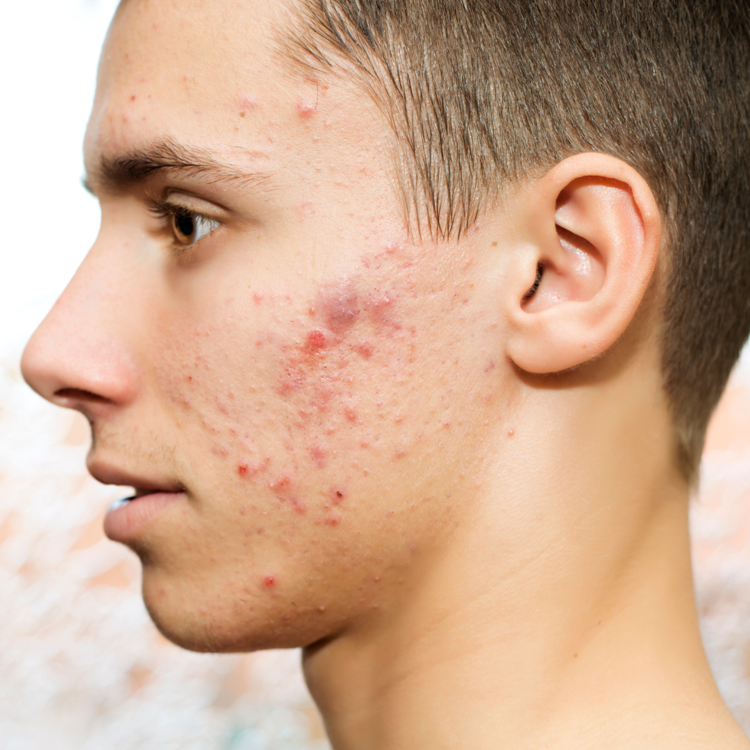 Alternatives to Accutane for Cystic Acne in Reston
