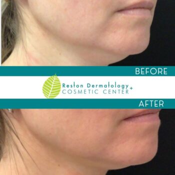 Cost of CoolSculpting Double Chin coolmini before and after northern virginia