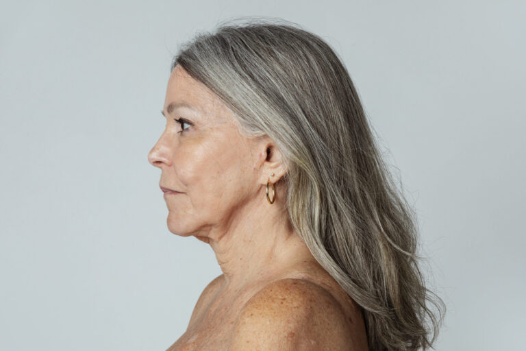 EmSculpt for Face After Rapid Weight Loss