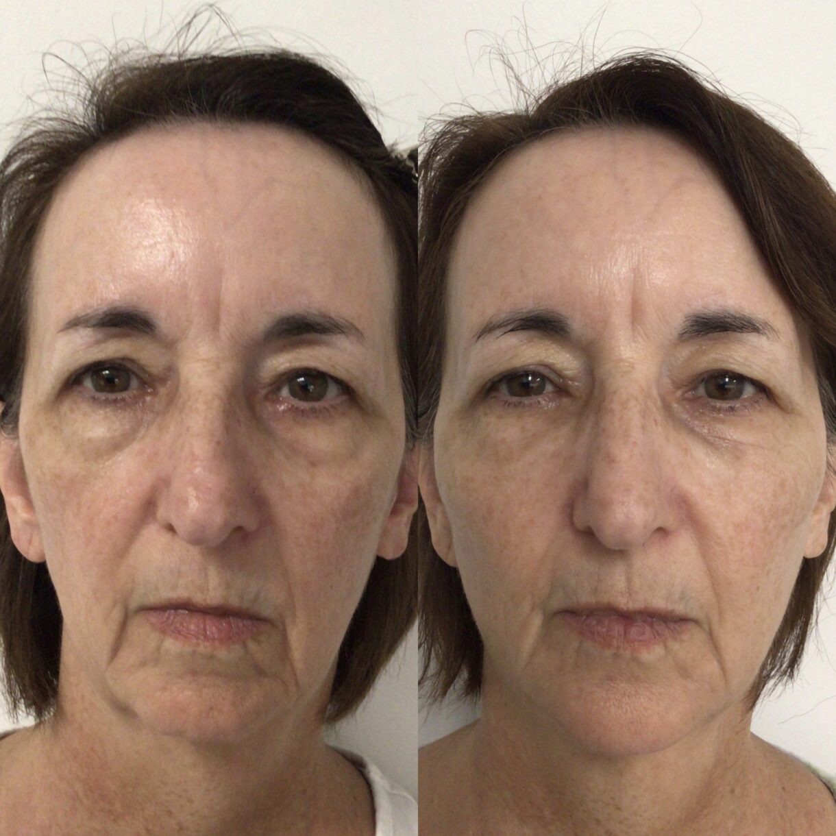 Facial Contouring Reston Dermatology Cosmetic Center