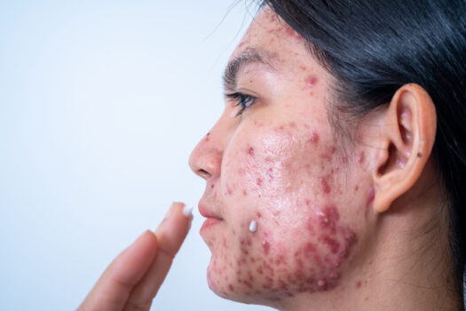 Best Acne Treatments for Teenagers Northern Virginia