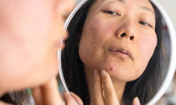 What Makes Acne Go Away Fast? Dermatologist Tips in Reston