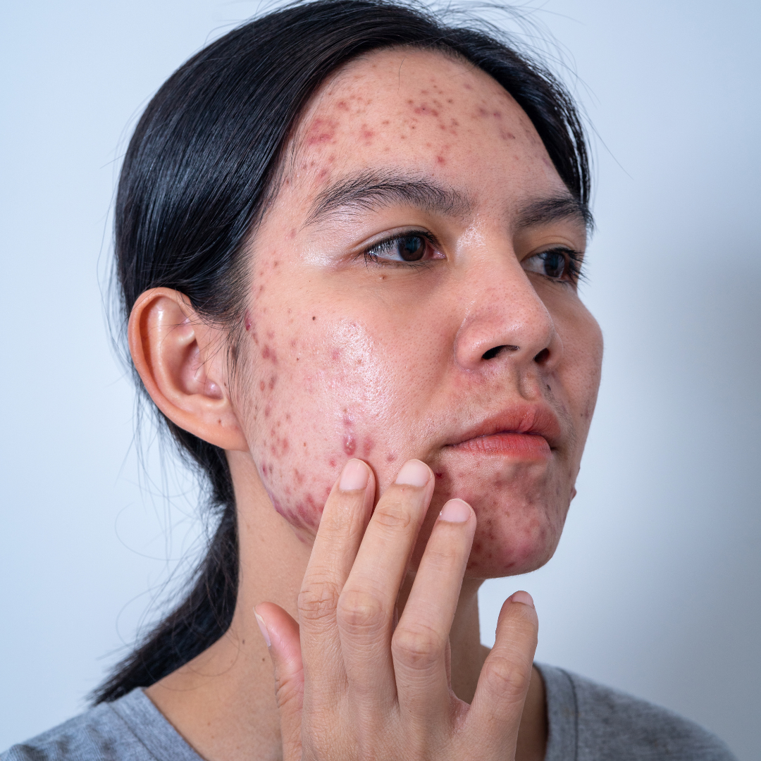 What Makes Acne Go Away Fast? Dermatologist Tips in Reston