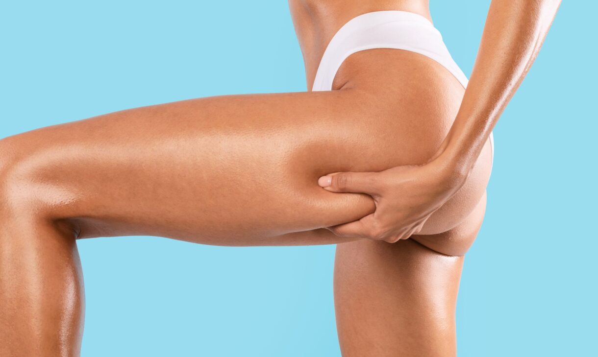 Can I Get Emsculpt for Cellulite in Reston?