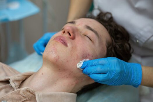 Top Reasons to Treat Acne Early in Reston Virginia