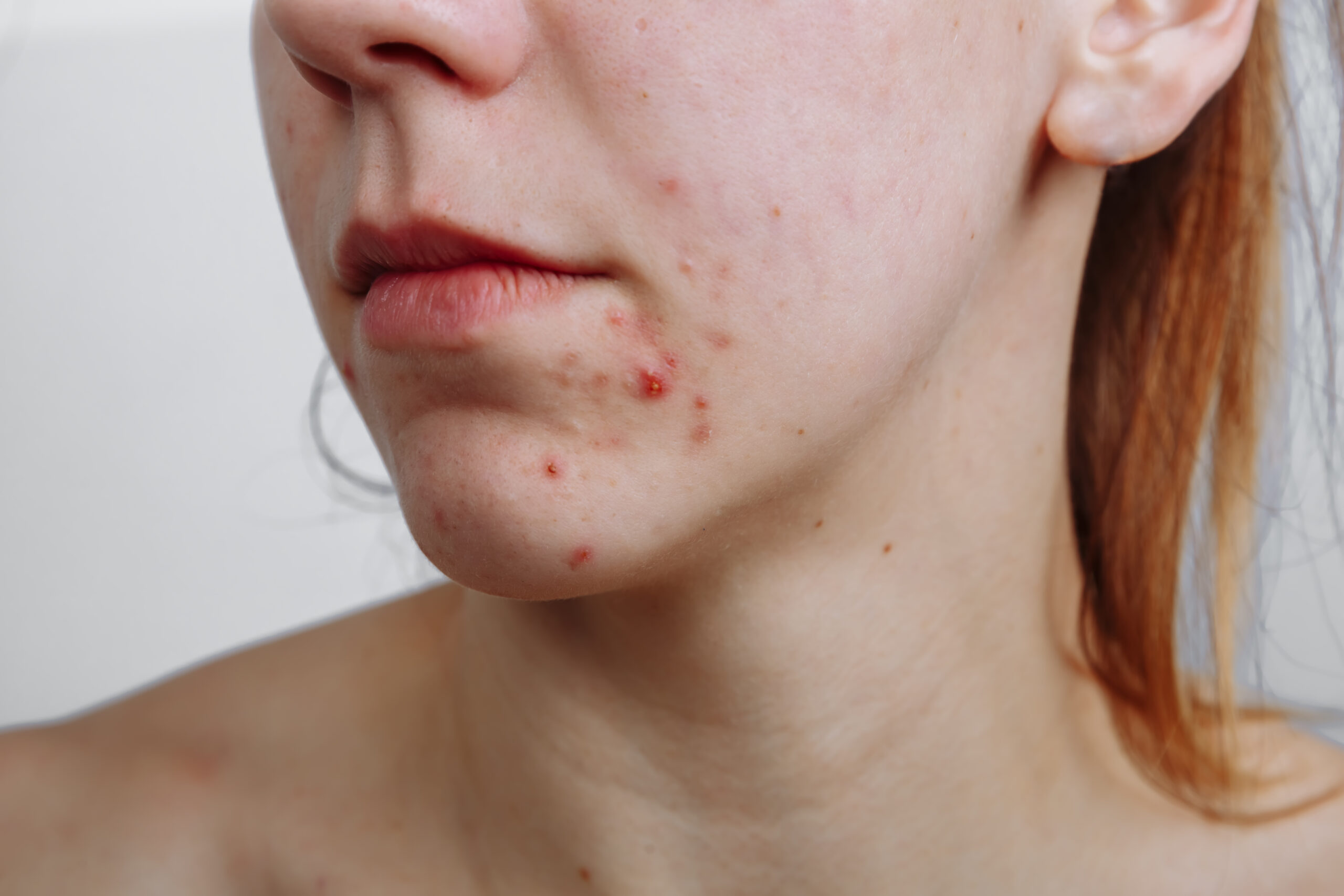 Treat Acne Early in Reston Virginia