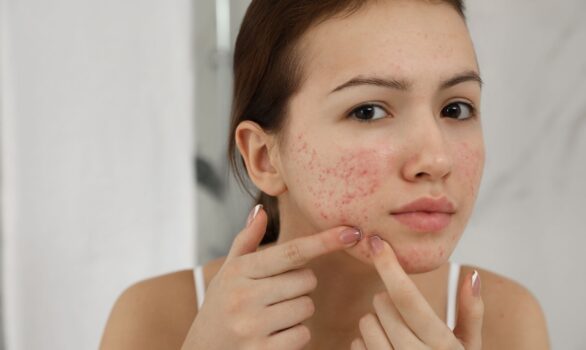 Dangers of Pimple Popping- Tips from a Reston Acne Dermatologist