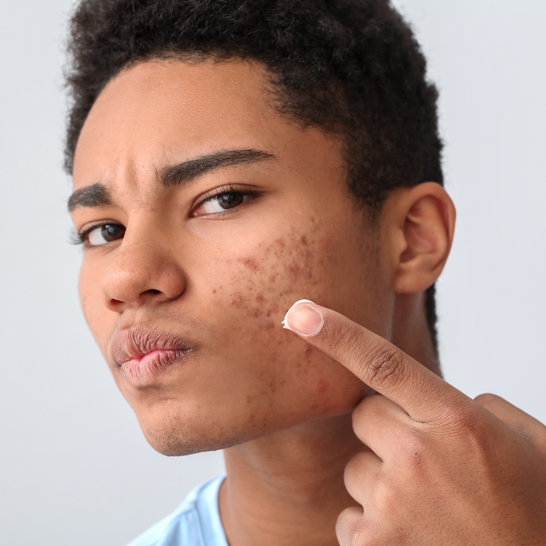 Dangers of Pimple Popping- Tips from a Reston Acne Dermatologist