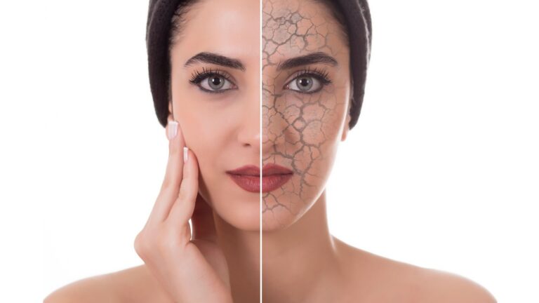Say Goodbye to Dry Skin This Winter: Expert Tips from a Dermatologist