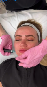 Hydrafacial with Sierra