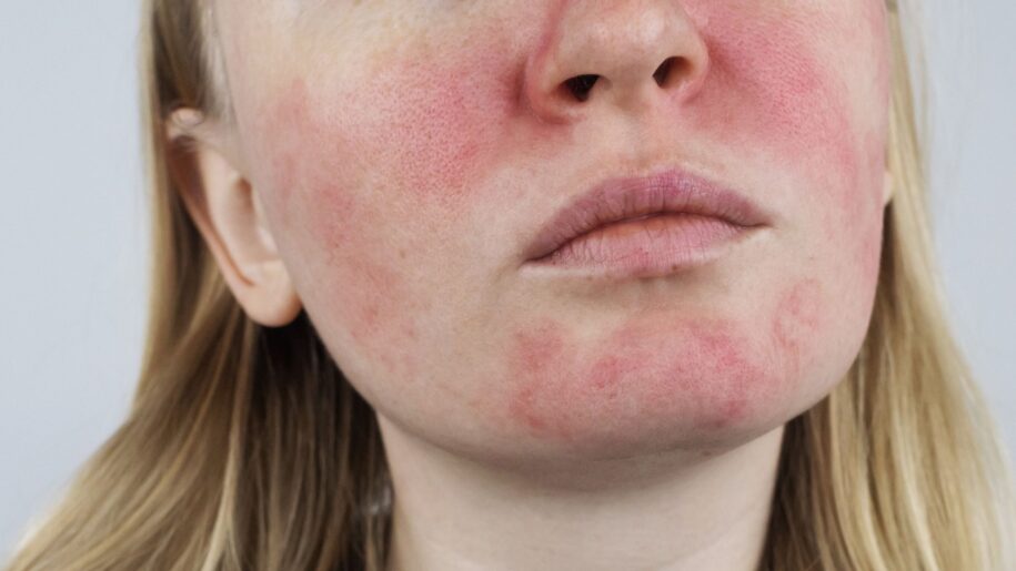 Top Rosacea Treatments in Reston Virginia