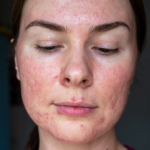 Top Rosacea Treatments in Reston Virginia