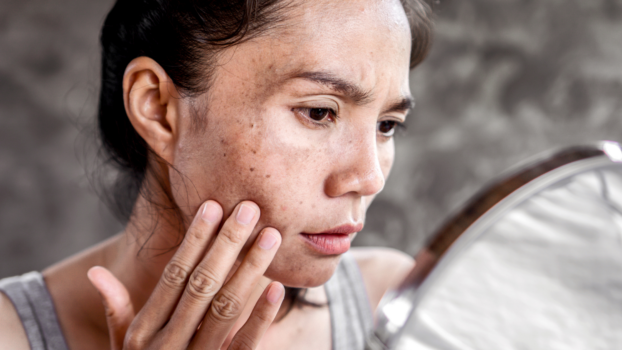 Best Dermatologist for Melasma Near Reston