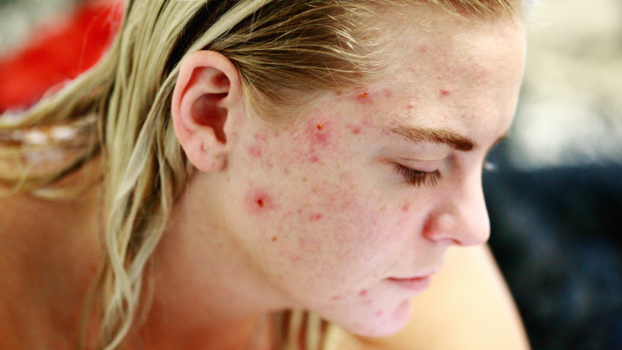 Cystic Acne Treatment in Reston