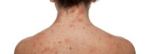 eczema specialist in Northern Virginia