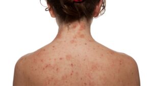 eczema specialist in Northern Virginia