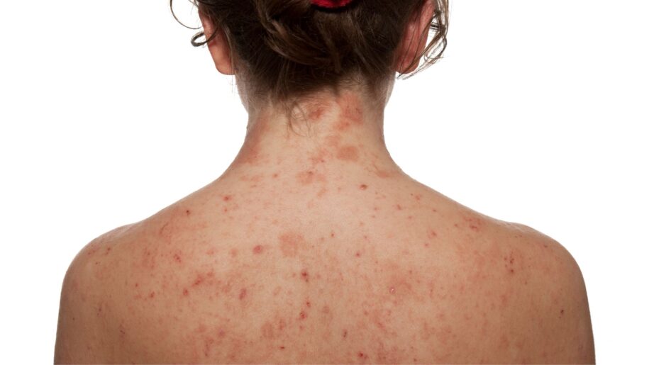 eczema specialist in Northern Virginia
