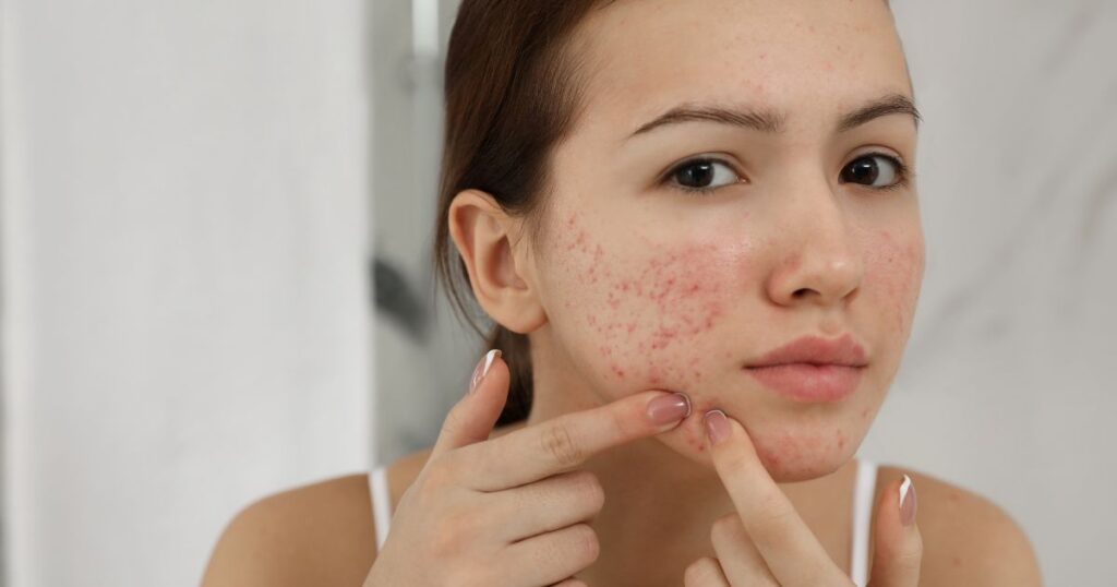 acne specialist near Ashburn