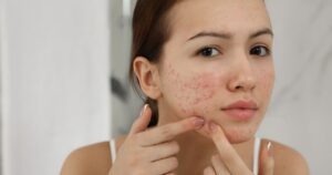acne specialist near Ashburn