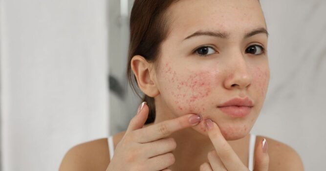 acne specialist near Ashburn