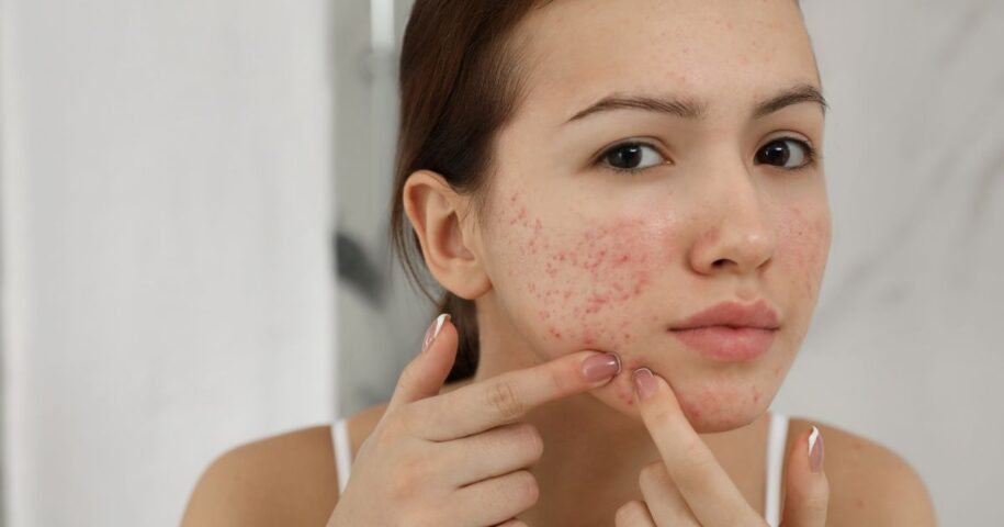 acne specialist near Ashburn