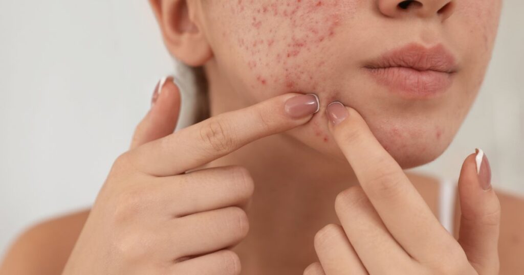 Accutane alternatives in Reston