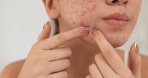 Accutane alternatives in Reston