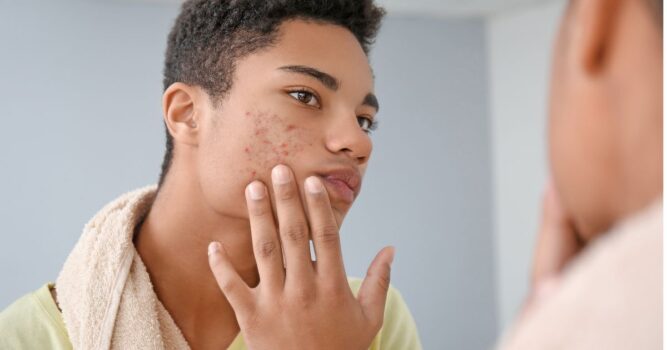 HydraFacial for teen acne in Reston