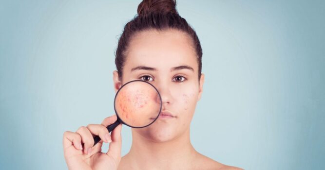 types of acne Reston