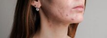 Reston Acne Specialist