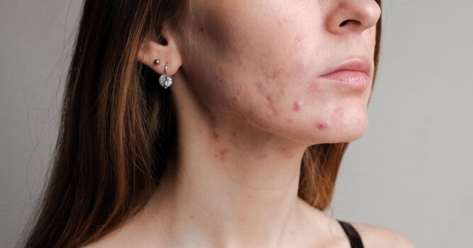 Reston Acne Specialist