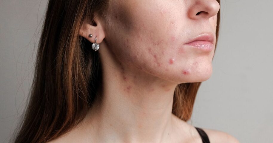 Reston Acne Specialist