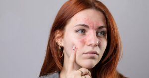 top rosacea treatments in Reston