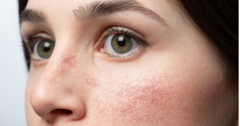 doctor for facial redness Reston