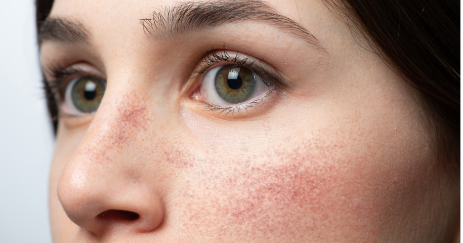 doctor for facial redness Reston